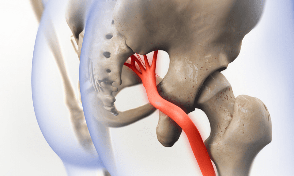 illustration of pinched nerve